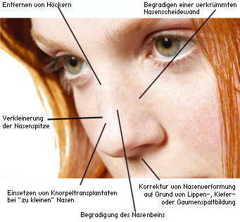 Nasenkorrektur (Korrektur der Nase)